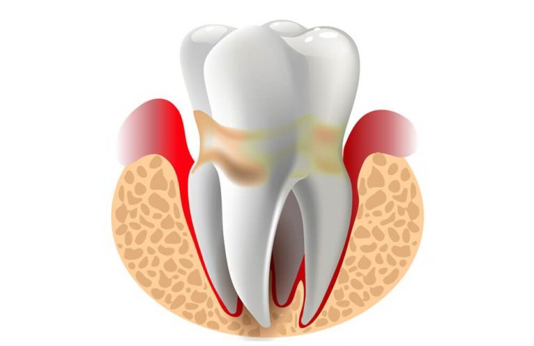 BỆNH VIÊM QUANH RĂNG (NHA CHU) NHỮNG ĐIỀU CẦN BIẾT VÀ CÁCH ĐIÊU TRỊ HIỆU QUẢ